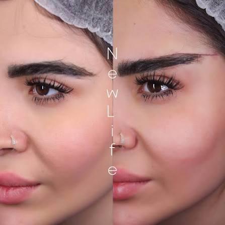 لیزر و زیبایی نیولایف